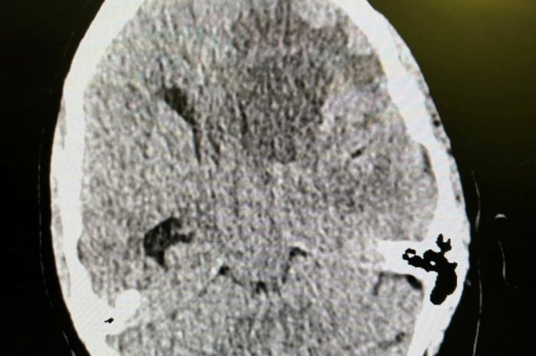 Marcus Williams' brain tumour scan. Photo released February 11 2025. A dad lost all memory of his family and even forgot his own name as a result of an aggressive brain tumour - after being misdiagnosed with vertigo.Marcus Williams, 35, began experiencing intense headaches, fatigue, and seizures but doctors repeatedly misdiagnosed his symptoms for vertigo.The dad-of-one started to lose his memory - and couldn't recognise his daughter, Lola, five - and his wife, Laura, 31, pushed to get a CT scan.It revealed a large tumour and Marcus was rushed for emergency surgery to remove 98% of the mass - after being given hours to live.
