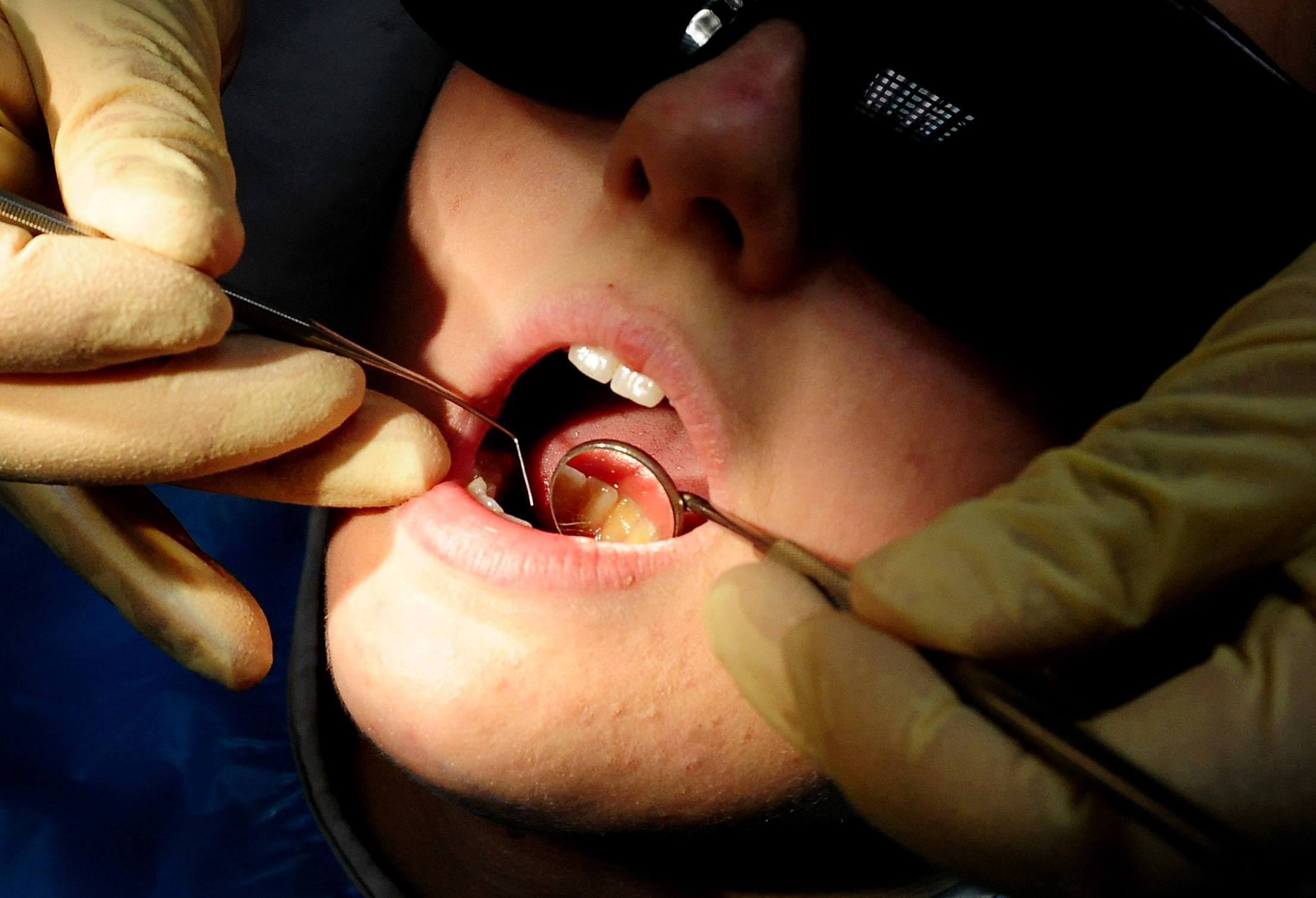 A third of children have rotting teeth in Cornwall