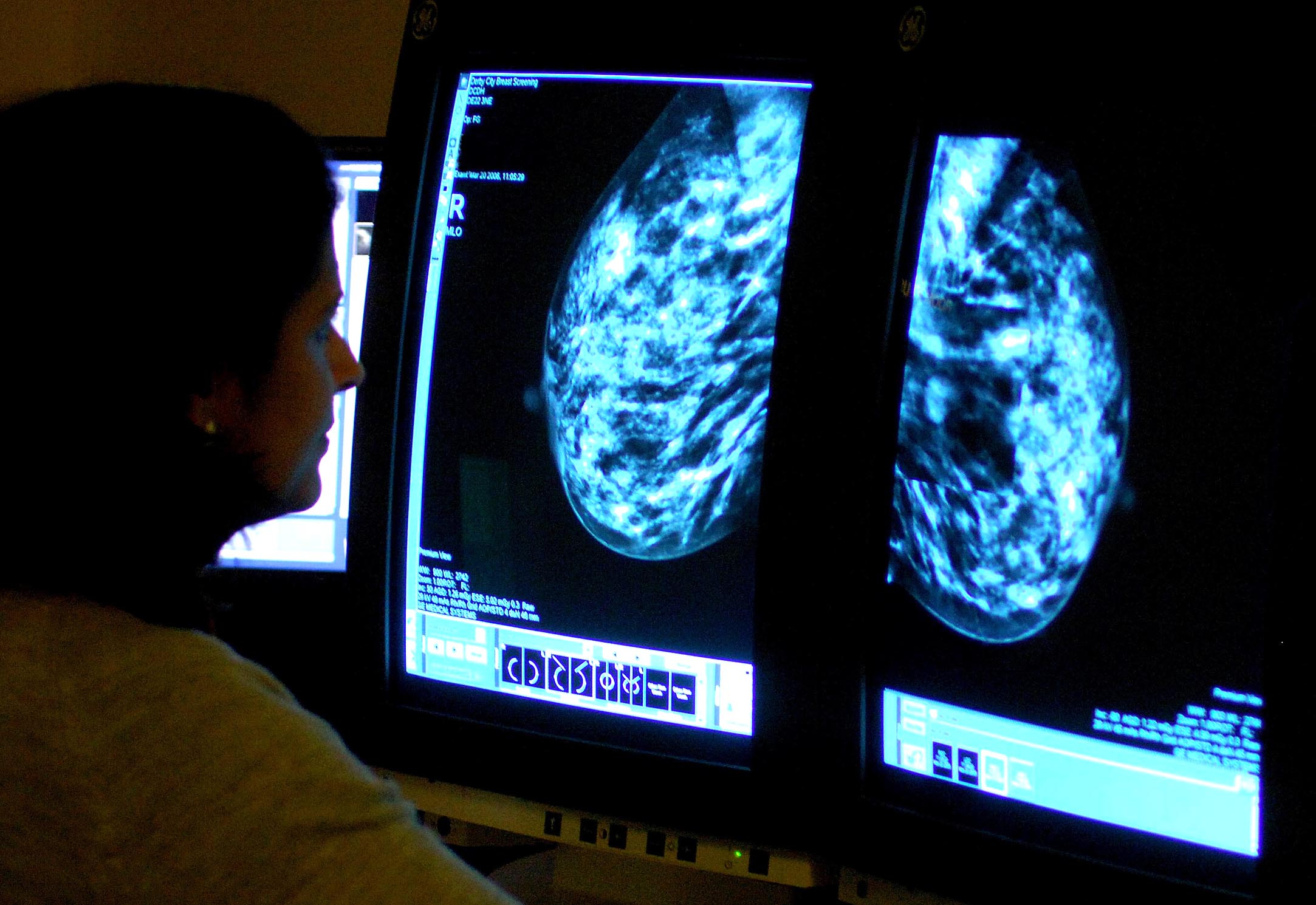 More women in Cornwall undergo breast cancer screening – as NHS England target met for first in five years