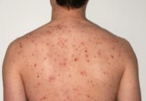 New NHS jab aims to cut chickenpox cases across Cornwall