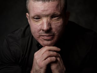 Truro victim fights "normalisation" of acid attacks