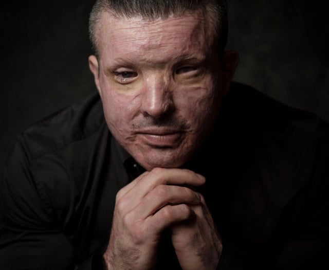 Truro victim fights "normalisation" of acid attacks