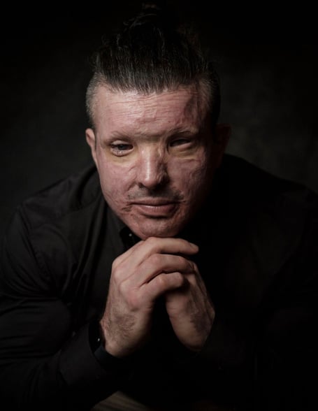 Andreas Christopheros was the victim of an acid attack in Truro in 2014
